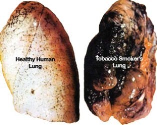 affected lungs of smoking