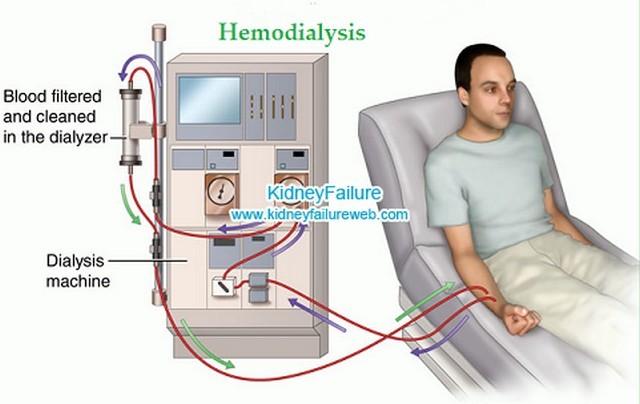 kidney failure DIALYSIS